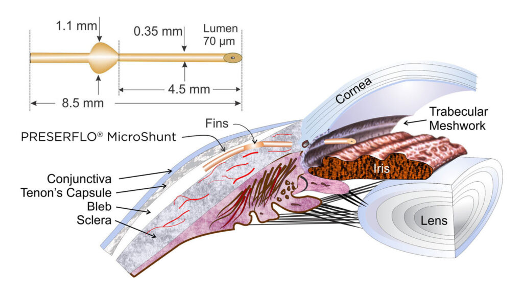 PRESERFLO™ MicroShunt – Mr Muneer Otri Consultant Opthalmologist