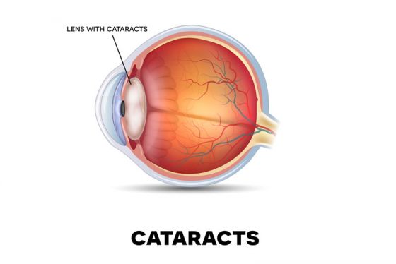 CATARACT SURGERY