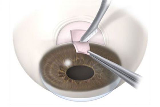 Glaucoma Filtration Surgery – Mr Muneer Otri Consultant Opthalmologist