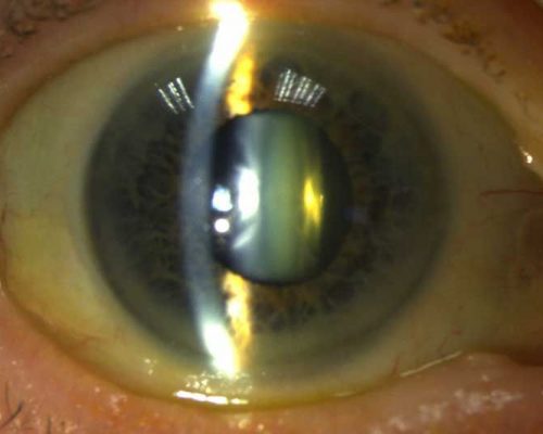 cataract-surgery-aug-mr-muneer-otri